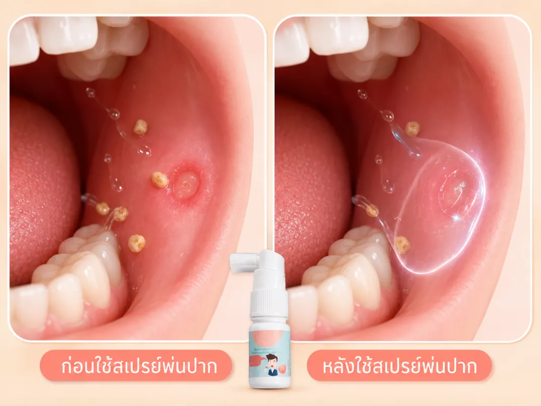 ภาพแสดงการเปรียบเทียบก่อนและหลังพ่นสเปรย์ในช่องปาก ก่อนพ่นแผลโดนกระตุ้นโดยอาหารและน้ำลาย หลังพ่นมีชั้นฟิล์มเคลือบปกป้อง